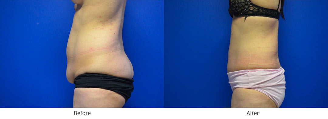 Abdominoplasty