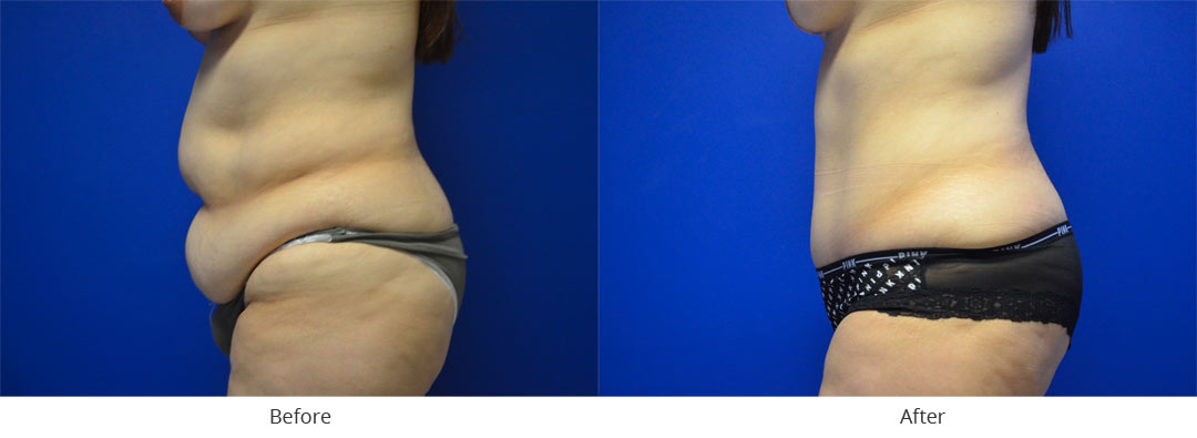 Abdominoplasty