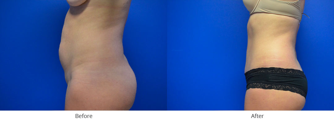 Abdominoplasty