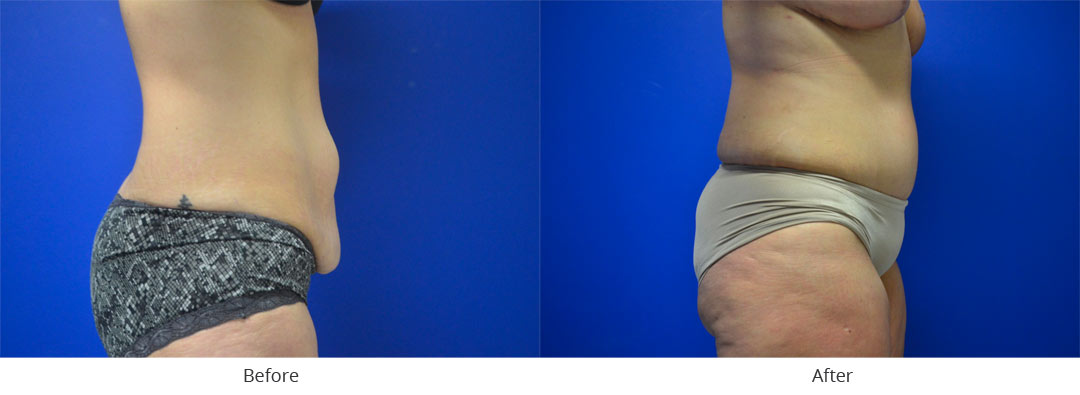 Abdominoplasty